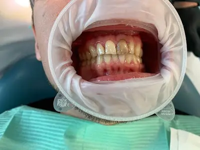 Dr Newdentaire - Implant Dentaire Belgique